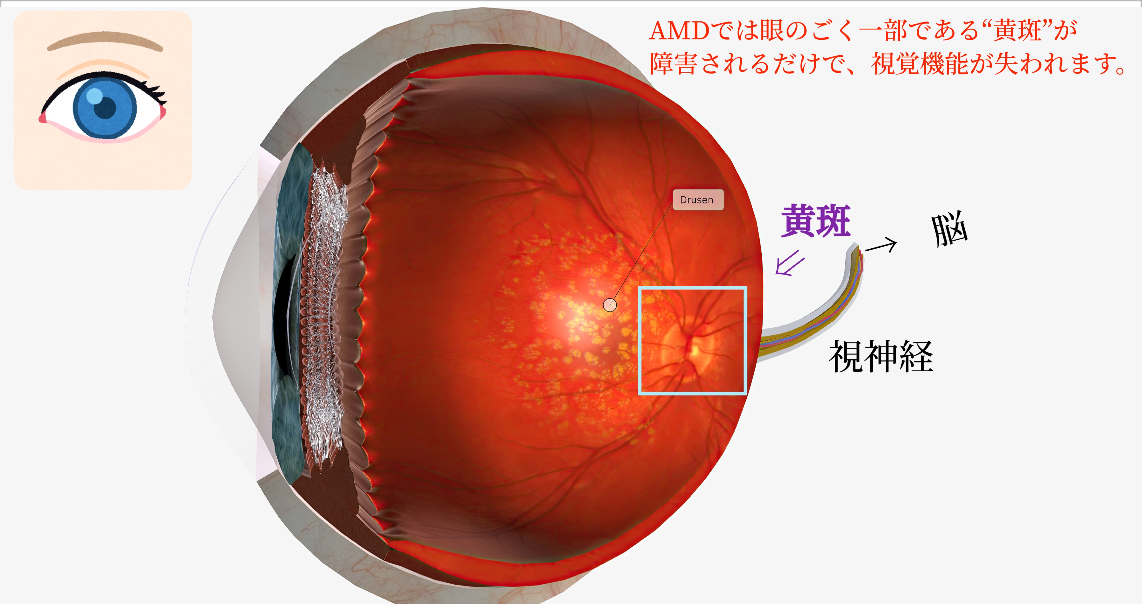 加齢黄斑変性　第二版　未裁断　AMD 加齢黄斑変性 - 新川崎眼科｜川崎市幸区北加瀬